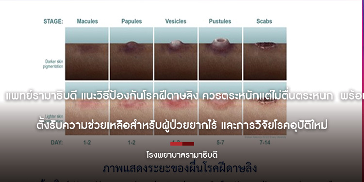 แพทย์รามาธิบดี แนะวิธีป้องกันโรคฝีดาษลิง ควรตระหนักแต่ไม่ตื่นตระหนก พร้อมตั้งรับความช่วยเหลือสำหรับผู้ป่วยยากไร้ และการวิจัยโรคอุบัติใหม่